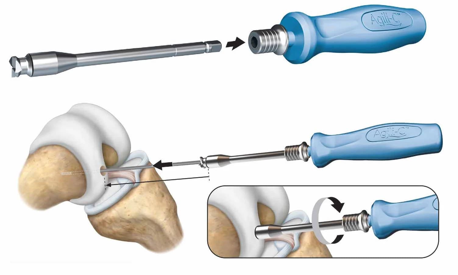 CartiHeal surgical illustration of osteochondral site preparation